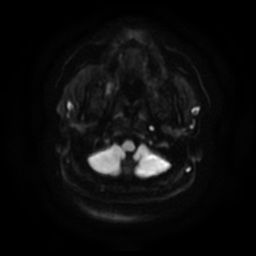 Chronic submandibular sialadenitis (Radiopaedia 61852-69885 Axial DWI 7).jpg