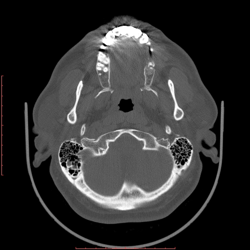 Chronic submandibular sialolithiasis (Radiopaedia 69817-79814 Axial bone window 6).jpg