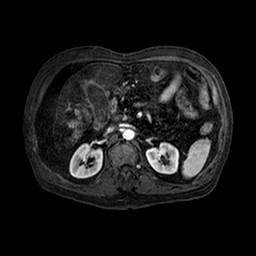 Cirrhosis and hepatocellular carcinoma in the setting of hemochromatosis (Radiopaedia 75394-86594 Axial T1 C+ fat sat 115).jpg