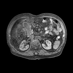 File:Cirrhosis and hepatocellular carcinoma in the setting of hemochromatosis (Radiopaedia 75394-86594 Axial T1 C+ fat sat 24).jpg