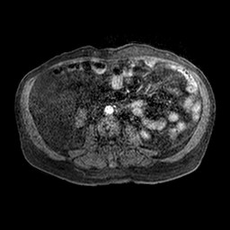 File:Cirrhosis and hepatocellular carcinoma in the setting of hemochromatosis (Radiopaedia 75394-86594 Axial T1 C+ fat sat 88).jpg