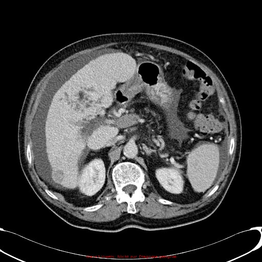File:Cirrhosis and hepatocellular carcinoma in the setting of hemochromatosis (Radiopaedia 75394-86595 B 32).jpg