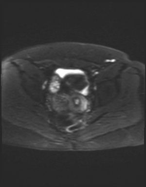 Class II Mullerian duct anomaly- unicornuate uterus with rudimentary horn and non-communicating cavity (Radiopaedia 39441-41755 Axial DWI 17).jpg