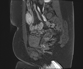 File:Class II Mullerian duct anomaly- unicornuate uterus with rudimentary horn and non-communicating cavity (Radiopaedia 39441-41755 G 34).jpg