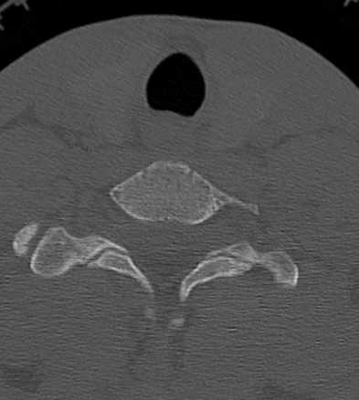 Clay-shoveler fracture (Radiopaedia 14604-14532 Axial bone window 40).jpg