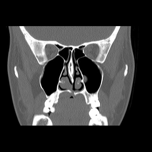 File:Cleft hard palate and alveolus (Radiopaedia 63180-71710 Coronal bone window 23).jpg