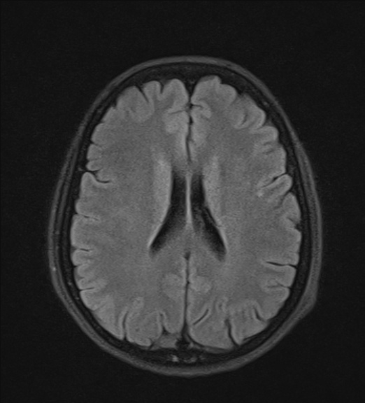 File:Clival meningioma (Radiopaedia 53278-59248 Axial FLAIR 16).jpg