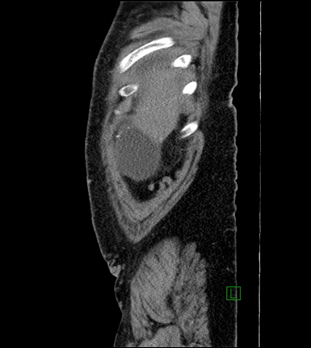 Closed-loop small bowel obstruction-internal hernia (Radiopaedia 78439-91096 C 129).jpg
