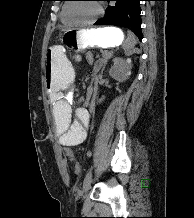 Closed-loop small bowel obstruction-internal hernia (Radiopaedia 78439-91096 C 58).jpg
