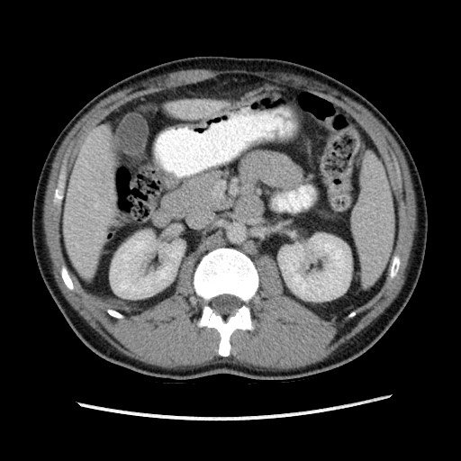 File:Closed-loop small bowel obstruction (Radiopaedia 73713-84509 A 63).jpg