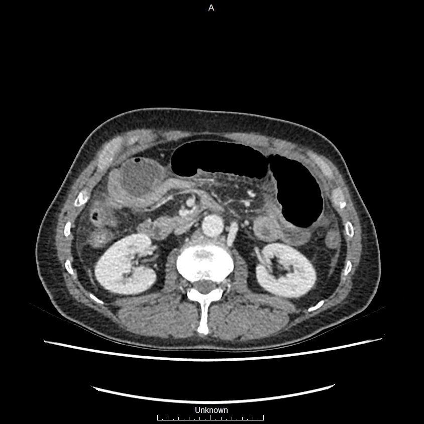 Closed loop bowel obstruction and ischemia (Radiopaedia 86959-103180 A 31).jpg