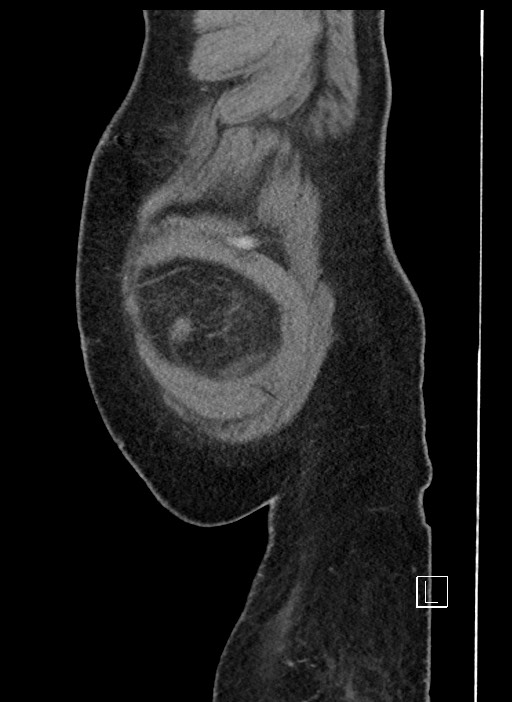 Closed loop obstruction - internal hernia into nephrectomy bed (Radiopaedia 59867-67320 C 107).jpg