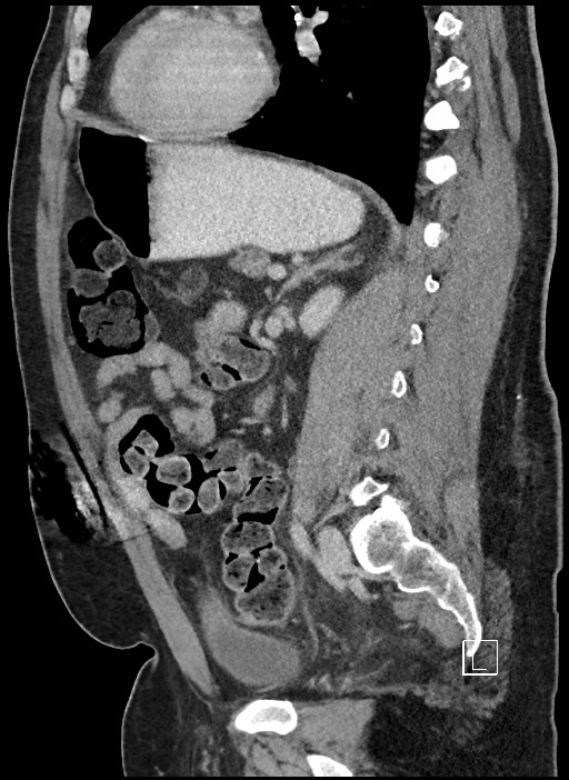 Closed loop obstruction - internal hernia into nephrectomy bed (Radiopaedia 59867-67320 C 33).jpg
