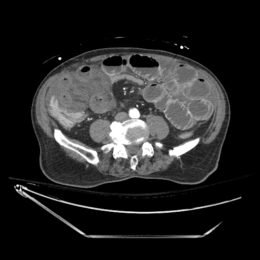 File:Closed loop obstruction due to adhesive band, resulting in small bowel ischemia and resection (Radiopaedia 83835-99023 B 94).jpg
