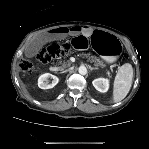 File:Closed loop small bowel obstruction - adhesive disease and hemorrhagic ischemia (Radiopaedia 86831-102990 A 74).jpg