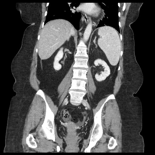 Closed loop small bowel obstruction - internal hernia (Radiopaedia 65402-74450 B 70).jpg
