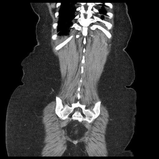 Closed loop small bowel obstruction - internal hernia (Radiopaedia 65402-74450 B 94).jpg