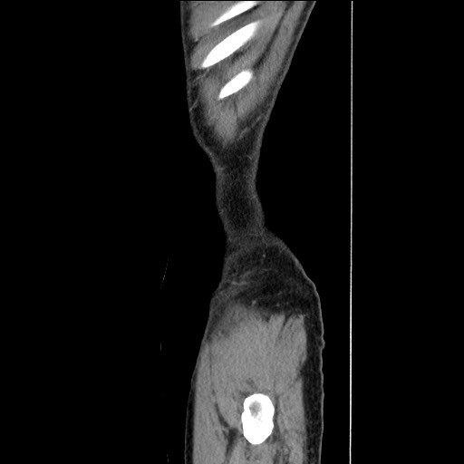 Closed loop small bowel obstruction - omental adhesion causing "internal hernia" (Radiopaedia 85129-100682 C 19).jpg
