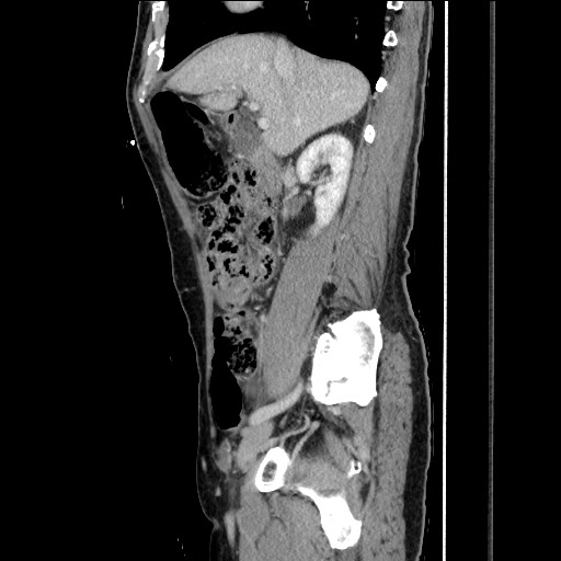 Closed loop small bowel obstruction - omental adhesion causing "internal hernia" (Radiopaedia 85129-100682 C 70).jpg