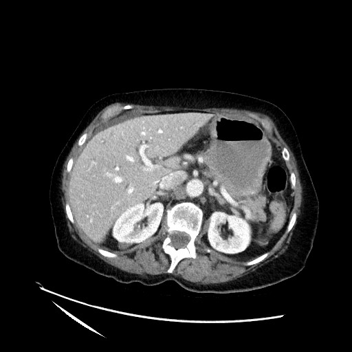 File:Closed loop small bowel obstruction due to adhesive band, with intramural hemorrhage and ischemia (Radiopaedia 83831-99017 Axial 77).jpg