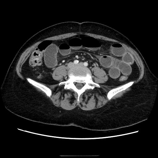 Closed loop small bowel obstruction due to adhesive bands - early and late images (Radiopaedia 83830-99015 A 104).jpg