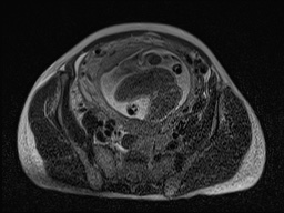 Closed loop small bowel obstruction in pregnancy (MRI) (Radiopaedia 87637-104031 D 21).jpg