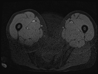 Closed loop small bowel obstruction in pregnancy (MRI) (Radiopaedia 87637-104031 G 71).jpg