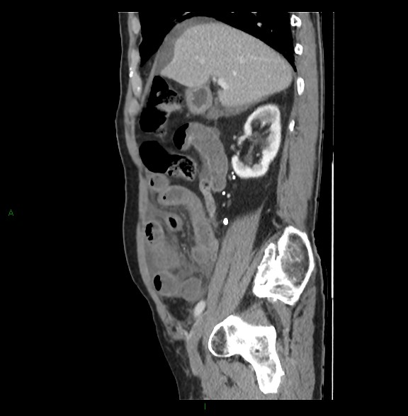 File:Closed loop small bowel obstruction with ischemia (Radiopaedia 84180-99456 C 31).jpg