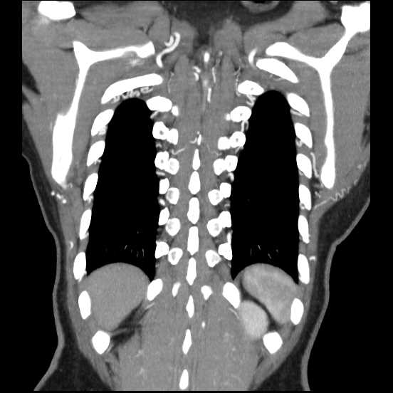 Coarctation of the aorta (Radiopaedia 67609-77010 B 11).jpg