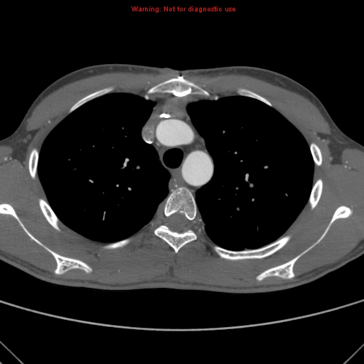 File:Coarctation of the aorta (Radiopaedia 9434-10118 A 53).jpg