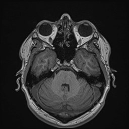 File:Cochlear incomplete partition type III associated with hypothalamic hamartoma (Radiopaedia 88756-105498 Axial T1 67).jpg