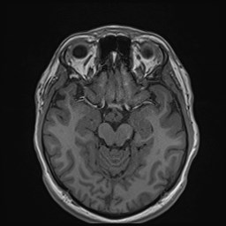 File:Cochlear incomplete partition type III associated with hypothalamic hamartoma (Radiopaedia 88756-105498 Axial T1 86).jpg