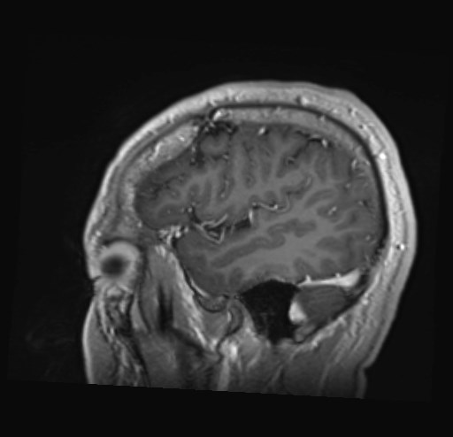 Cochlear incomplete partition type III associated with hypothalamic hamartoma (Radiopaedia 88756-105498 Sagittal T1 C+ 11).jpg