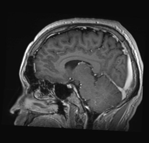 Cochlear incomplete partition type III associated with hypothalamic hamartoma (Radiopaedia 88756-105498 Sagittal T1 C+ 30).jpg