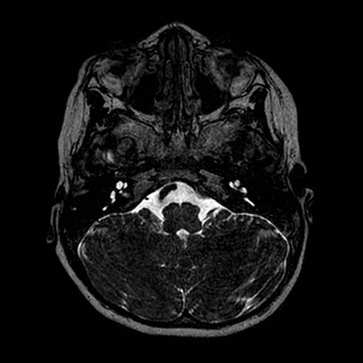 File:Cochlear nerve aplasia - unilateral (Radiopaedia 87910-104413 Axial T2 14).jpg