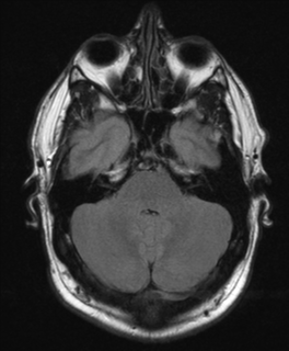 File:Colloid cyst (Radiopaedia 44510-48181 Axial FLAIR 7).png