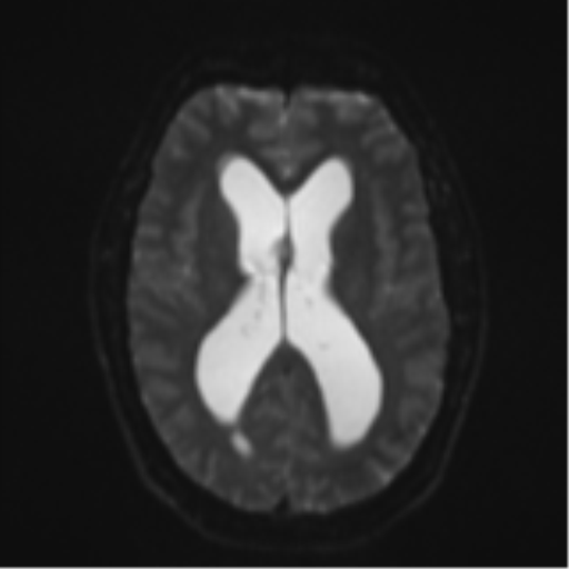 Colloid cyst (Radiopaedia 53164-59125 Axial DWI 16).png