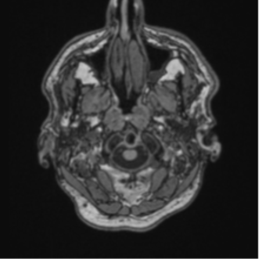 File:Colloid cyst of the third ventricle (Radiopaedia 86571-102662 Axial T1 7).png