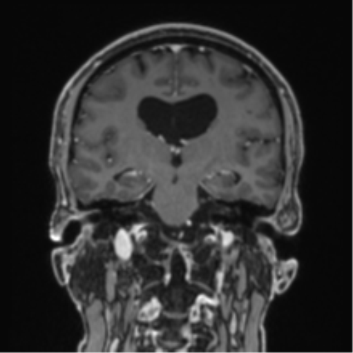 File:Colloid cyst of the third ventricle (Radiopaedia 86571-102662 Coronal T1 C+ 47).png