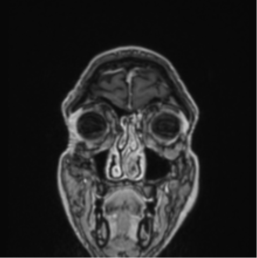 File:Colloid cyst of the third ventricle (Radiopaedia 86571-102662 Coronal T1 C+ 83).png