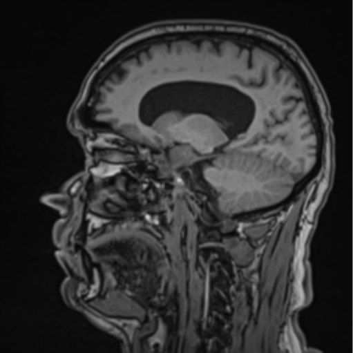 File:Colloid cyst of the third ventricle (Radiopaedia 86571-102662 Sagittal T1 47).png