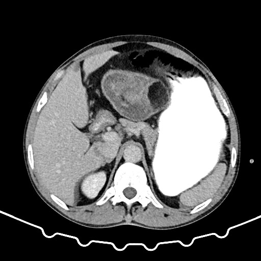 Colocolic intussusception due to large lipoma (Radiopaedia 68773-78482 A 42).jpg