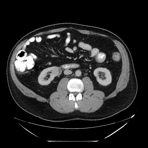 Colocolic intussusception due to lipoma (Radiopaedia 73712-84508 A 57).jpg