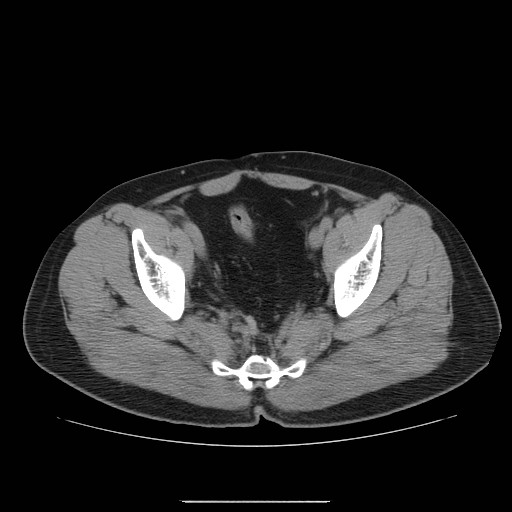 File:Colocutaneous fistula in Crohn's disease (Radiopaedia 29586-30093 Axial non-contrast 33).jpg