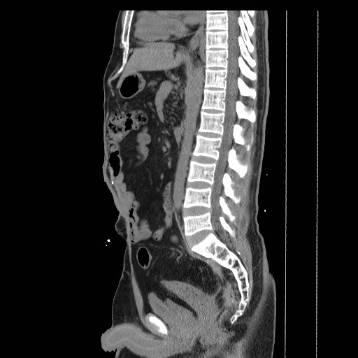 File:Colocutaneous fistula in Crohn's disease (Radiopaedia 29586-30093 C 24).jpg