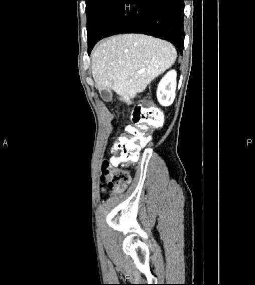 Colon adenocarcinoma - hepatic flexure (Radiopaedia 85635-101395 D 14).jpg