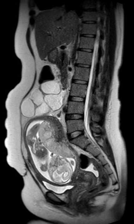 Colon adenocarcinoma with Krukenberg tumors, advanced pregnancy (Radiopaedia 67279-76645 Sagittal T2 27).jpg