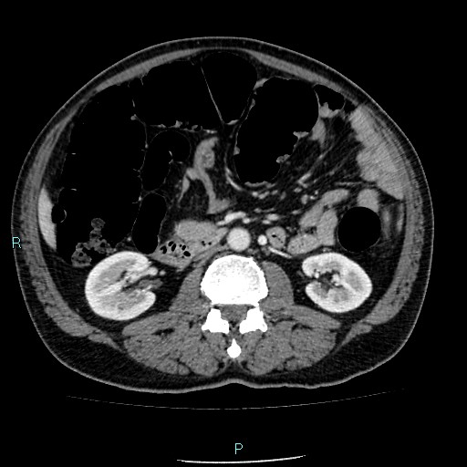 Colon adenocarcinoma with calcific liver metastasis (Radiopaedia 55745-62300 B 20).jpg