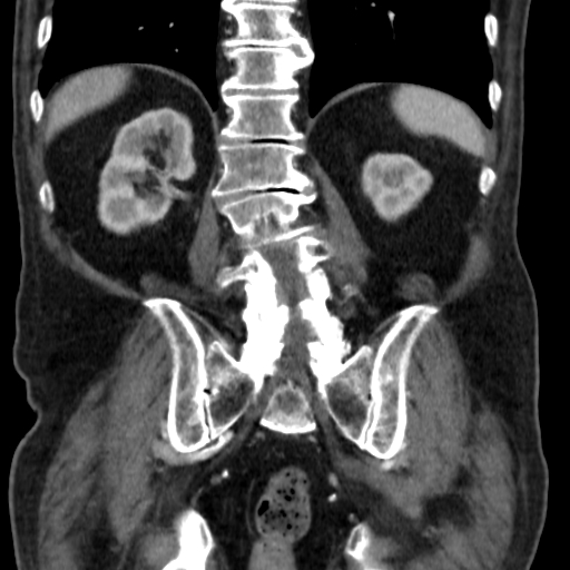 File:Colon cancer with duodenal invasion (Radiopaedia 16278-15958 B 45).jpg
