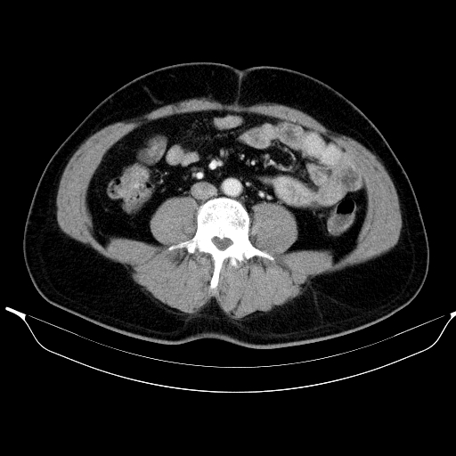 Colonic lipoma with colo-colic intussusception (Radiopaedia 58944-66200 A 38).jpg